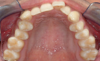 dental treatment with orthodontics before photos