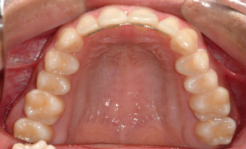 dental treatment with orthodontics after photos