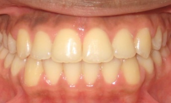 Correct irregular teeth by Garyslake orthodontists