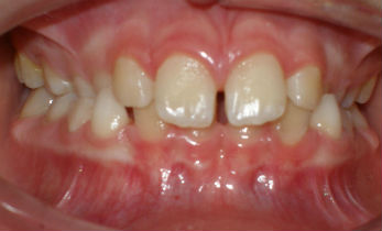 an Overbite teeth
