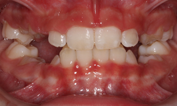 Dental Implants after