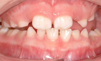 Invisible Braces example before photo