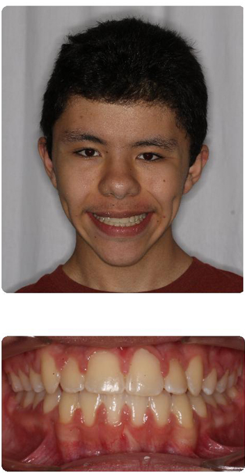 Kenilworth invisalign after photo