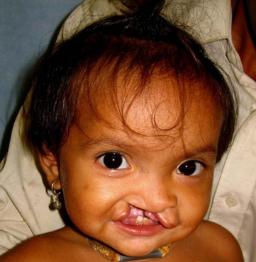 Cleft Lip and Palate Case One