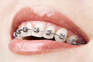 Grayslake braces