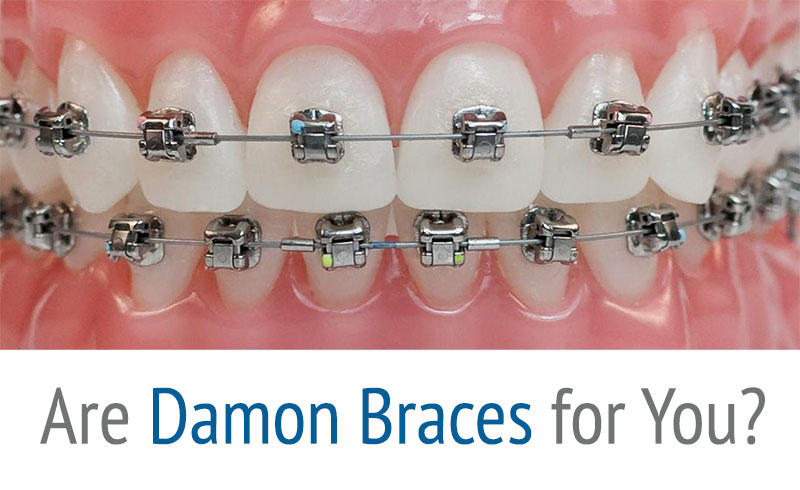 damon-braces