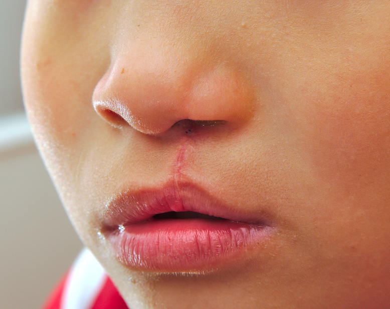 Boy showing a monolateral cleft lip repaired