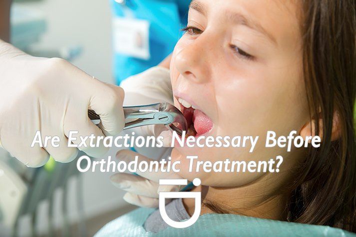 extractions before orthodontic treatment