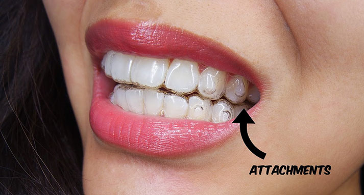 Reaksi Alergi Terhadap Invisalign- Global Estetik Dental Care