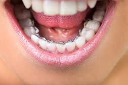 lingual braces for adults