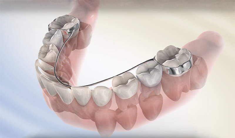 Lower Lingual Holding Arch Appliance Explained - iDentity Orthodontics