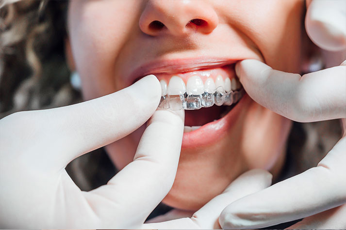 Doctor putting a clear dental aligner to the patient woman