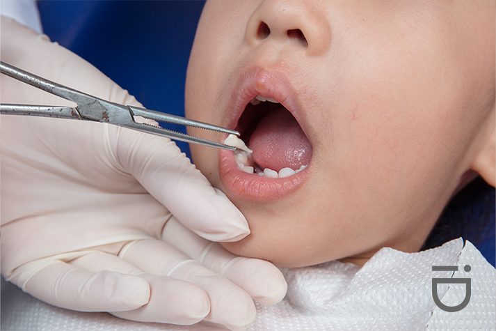 Extracting Baby Teeth For Proper Eruption