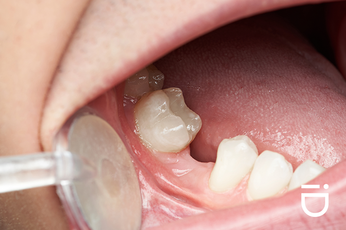 missing teeth adult orthodontic patient