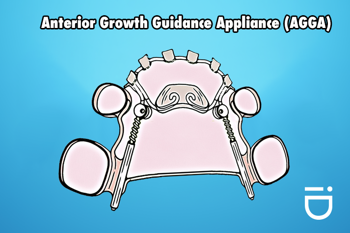 Anterior Growth Guidance Appliance (AGGA)